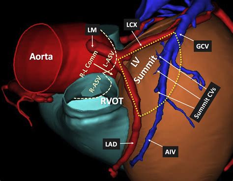 lv summit ablation|left ventricular outflow tract ablation.